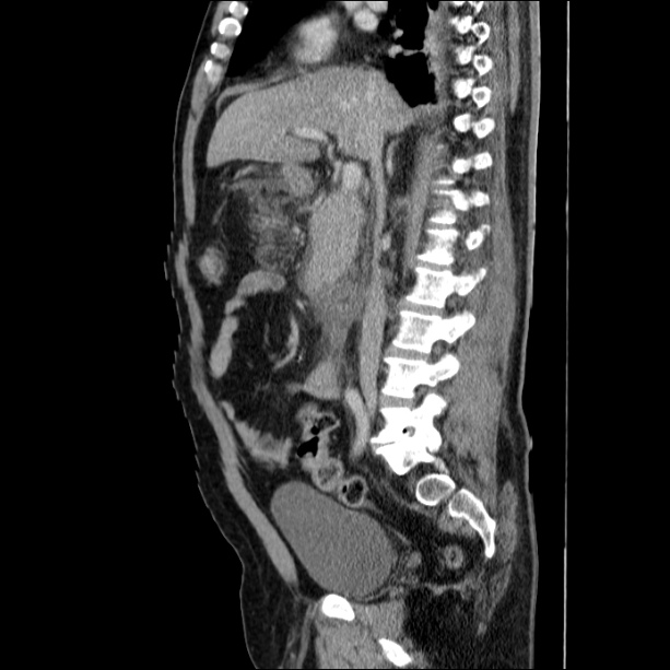 Acute pancreatitis (Radiopaedia 26663-26813 Sagittal C+ portal venous phase 33).jpg