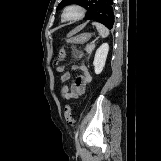 Acute pancreatitis (Radiopaedia 26663-26813 Sagittal C+ portal venous phase 56).jpg