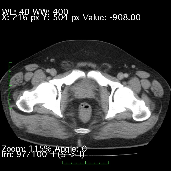 Acute pancreatitis (Radiopaedia 34043-35276 Axial C+ portal venous phase 97).jpg