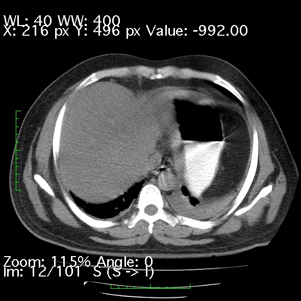 File:Acute pancreatitis (Radiopaedia 34043-35276 Axial non-contrast 12).jpg