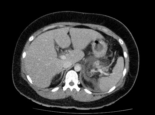 Acute pancreatitis (Radiopaedia 69236-79012 Axial C+ portal venous phase 26).jpg