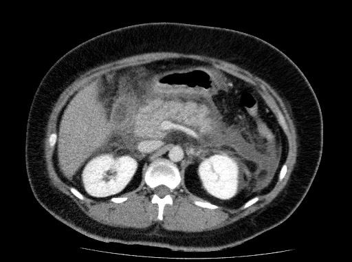 Acute pancreatitis (Radiopaedia 69236-79012 Axial C+ portal venous phase 34).jpg