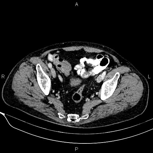 Acute pancreatitis (Radiopaedia 85146-100701 Axial C+ portal venous phase 56).jpg