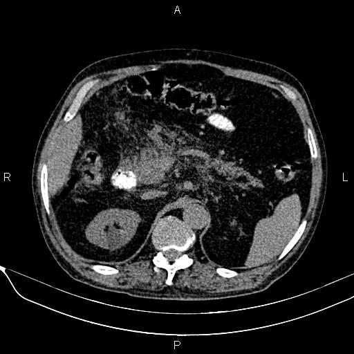 File:Acute pancreatitis (Radiopaedia 85146-100701 Axial non-contrast 42).jpg