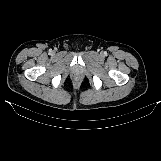Acute pancreatitis (Radiopaedia 87428-103757 Axial C+ portal venous phase 98).jpg