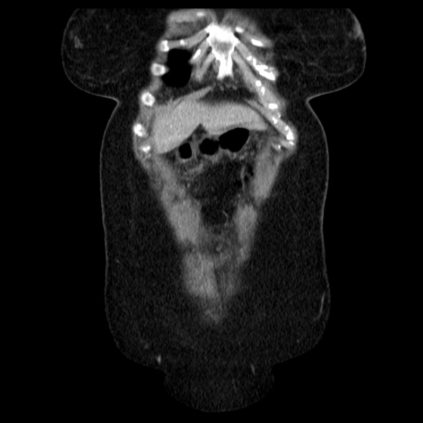 Acute pancreatitis - Balthazar C (Radiopaedia 26569-26714 Coronal C+ portal venous phase 14).jpg