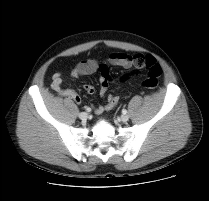 Acute pancreatitis - Balthazar E (Radiopaedia 23080-23110 Axial C+ portal venous phase 56).jpg