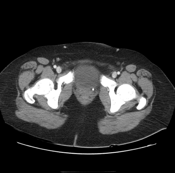 Acute pancreatitis - Balthazar E (Radiopaedia 29016-29377 Axial C+ portal venous phase 73).png