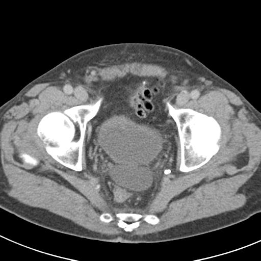 Acute pancreatitis and walled-off necrosis (Radiopaedia 29888-30403 Axial C+ delayed 77).jpg