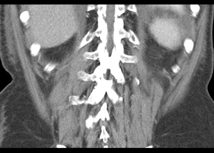 Acute pancreatitis and walled-off necrosis (Radiopaedia 29888-30403 Coronal C+ portal venous phase 47).jpg