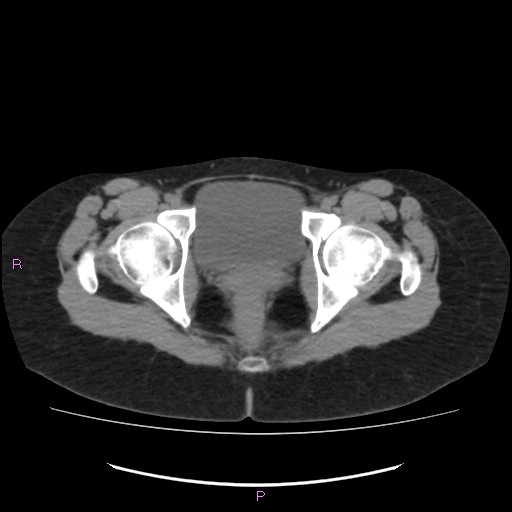 Acute pancreatitis secondary to stone at minor papilla and pancreatic divisum (Radiopaedia 76570-88333 Axial non-contrast 76).jpg
