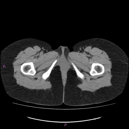 Acute pancreatitis secondary to stone at minor papilla and pancreatic divisum (Radiopaedia 76570-88333 Axial non-contrast 87).jpg