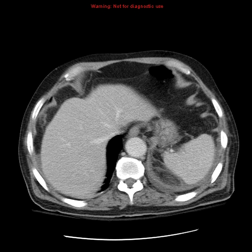 File:Acute pancreatitis with incidental pancreatic lipoma (Radiopaedia 10190-10730 Axial C+ portal venous phase 10).jpg