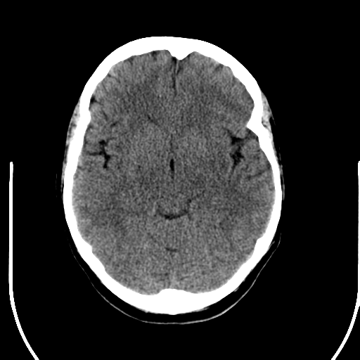 File:Acute pontine infarct from vertebral artery dissection (Radiopaedia 34111-35369 Axial non-contrast 12).png