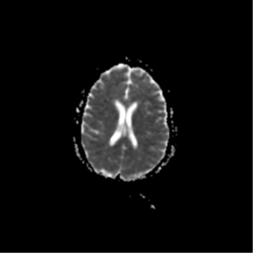 File:Acute pontine infarct from vertebral artery dissection (Radiopaedia 34111-35370 Axial ADC 14).png