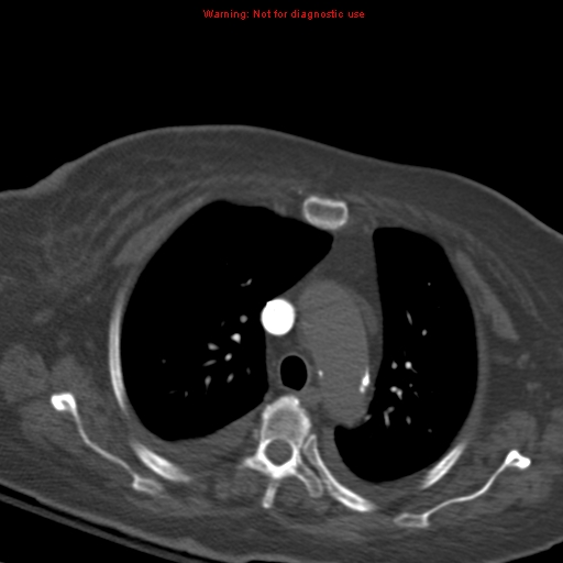 Acute pulmonary embolism (Radiopaedia 13286-13289 Axial C+ CTPA 22).jpg