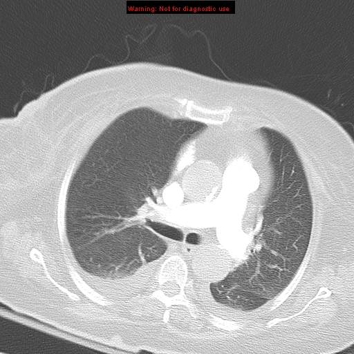 File:Acute pulmonary embolism (Radiopaedia 13286-13289 B 18).jpg
