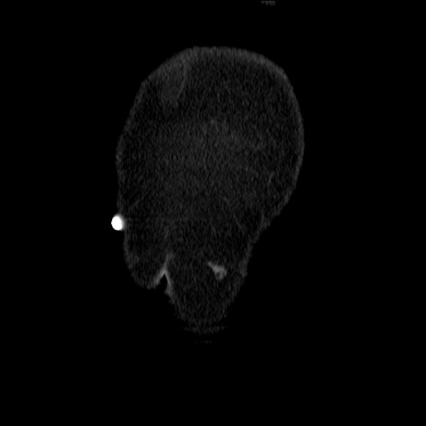 Acute pyelonephritis (Radiopaedia 26584-26729 C+ portal venous phase 4).jpg
