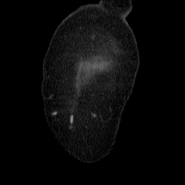 Acute pyelonephritis (Radiopaedia 26584-26729 C+ portal venous phase 6).jpg