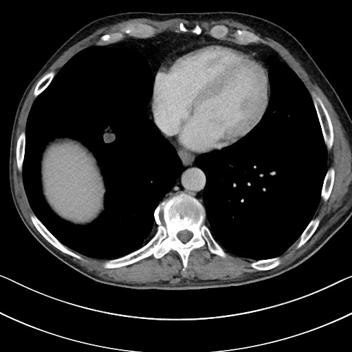 Acute renal infarction - rim capsular enhancement (Radiopaedia 59833-67270 Axial C+ portal venous phase 6).jpg
