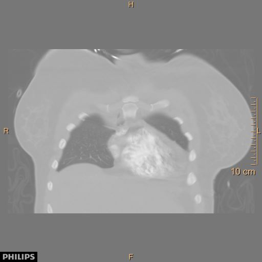 File:Acute reversible pulmonary hypertension and right heart failure from cocaine toxicity (Radiopaedia 49394-54517 Coronal C+ CTPA 3).jpg