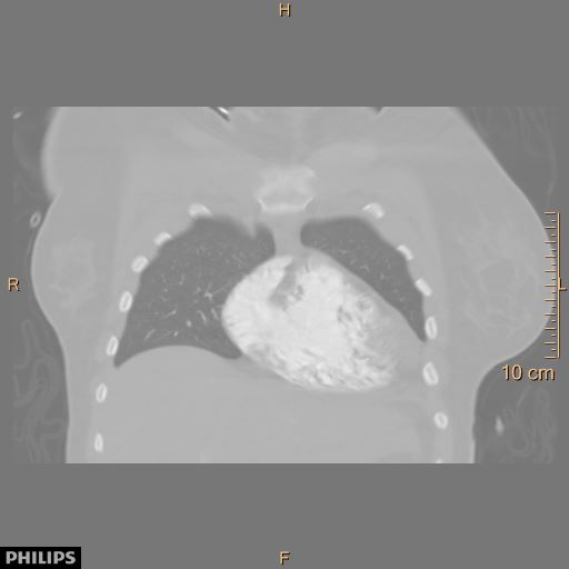 File:Acute reversible pulmonary hypertension and right heart failure from cocaine toxicity (Radiopaedia 49394-54517 Coronal C+ CTPA 6).jpg