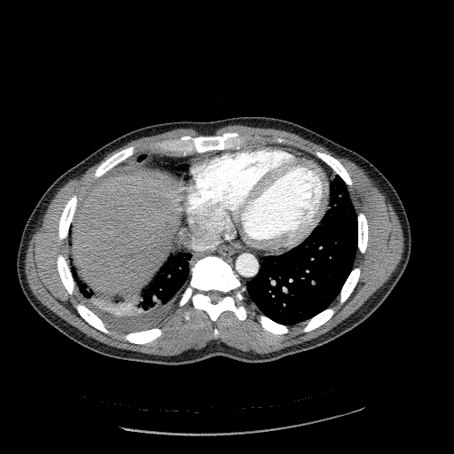 File:Acute segmental pulmonary emboli and pulmonary infarction (Radiopaedia 62264-70444 Axial C+ CTPA 83).jpg