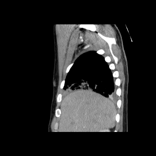 File:Acute segmental pulmonary emboli and pulmonary infarction (Radiopaedia 62264-70444 Sagittal C+ CTPA 14).jpg