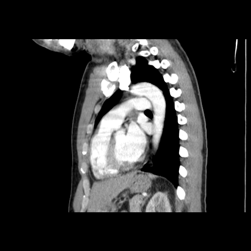 File:Acute segmental pulmonary emboli and pulmonary infarction (Radiopaedia 62264-70444 Sagittal C+ CTPA 42).jpg