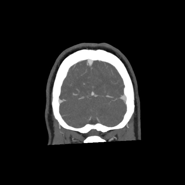 Acute subarachnoid hemorrhage and accessory anterior cerebral artery (Radiopaedia 69231-79009 Coronal C+ arterial phase 71).jpg