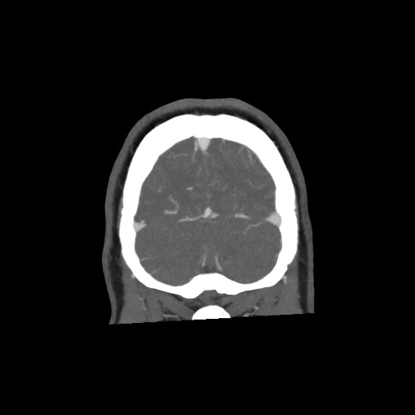 Acute subarachnoid hemorrhage and accessory anterior cerebral artery (Radiopaedia 69231-79009 Coronal C+ arterial phase 72).jpg
