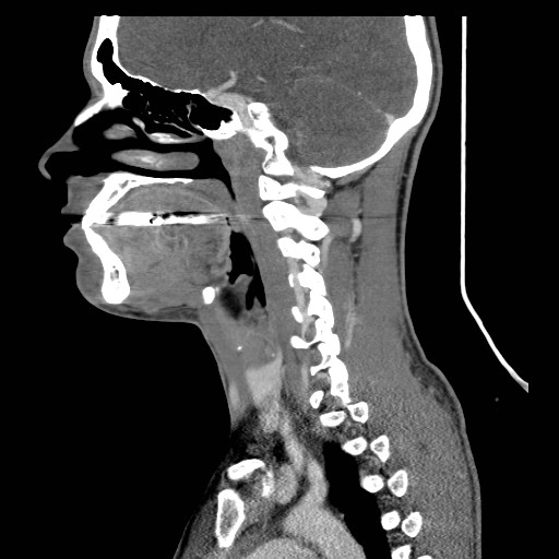 File:Acute submandibular sialadenitis secondary to ductal stone (Radiopaedia 27999-28267 Sagittal C+ delayed 26).jpg