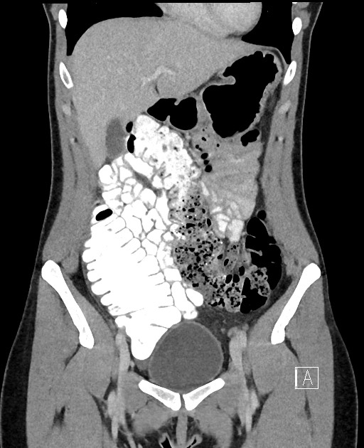 Acute uncomplicated appendicitis (Radiopaedia 61374-69304 Coronal C+ portal venous phase 30).jpg