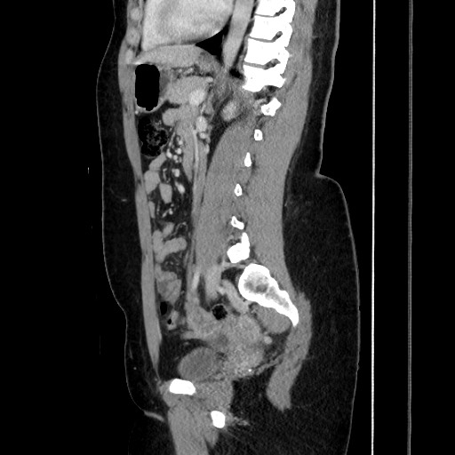 File:Acute uncomplicated appendicitis (Radiopaedia 73704-84499 Sagittal C+ portal venous phase 127).jpg