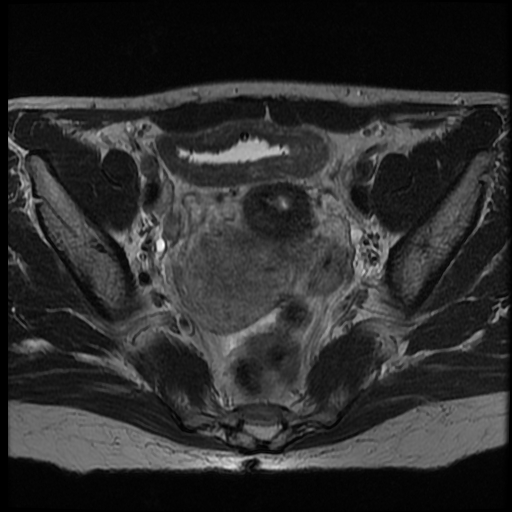 File:Adenocarcinoma arising in a urethral diverticulum (Radiopaedia 12400-12657 Axial T2 5).jpg