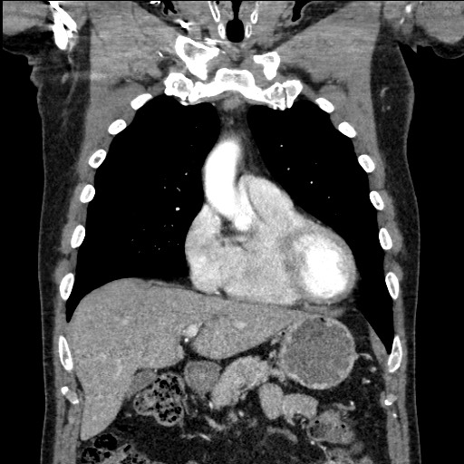Adenocarcinoma of the lung (Radiopaedia 59871-67325 Coronal C+ arterial phase 19).jpg