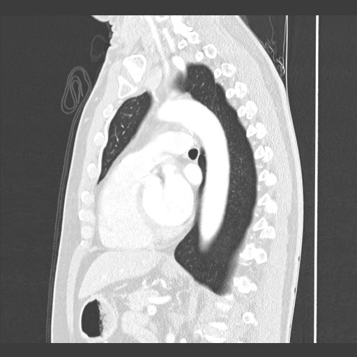 Adenocarcinoma of the lung (Radiopaedia 59871-67325 Sagittal lung window 60).jpg