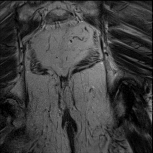 File:Adenocarcioma of rectum- T1 lesion (Radiopaedia 36921-38546 Coronal T2 2).png