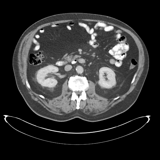 Adenocarcioma of rectum- T1 lesion (Radiopaedia 36921-38547 Axial C+ portal venous phase 39).png
