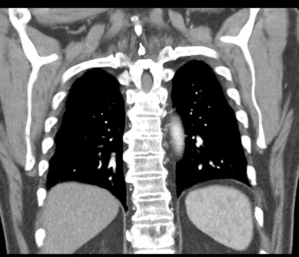 File:Adenocarcioma of rectum- T1 lesion (Radiopaedia 36921-38547 Coronal C+ arterial phase 48).png