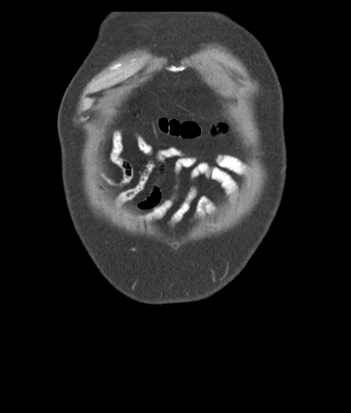 Adenocarcioma of rectum- T1 lesion (Radiopaedia 36921-38547 Coronal C+ portal venous phase 6).png