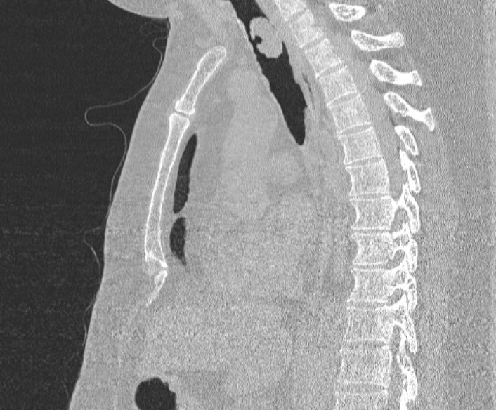 Adenoid cystic carcinoma of the trachea (Radiopaedia 49042-54137 Sagittal lung window 242).jpg