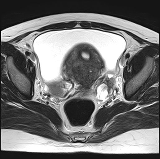 File:Adenomyosis - ovarian endometriomas (Radiopaedia 67031-76350 Axial T2 16).jpg
