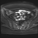 File:Adenomyosis and endometriotic cysts (Radiopaedia 82300-96367 Axial DWI 17).jpg