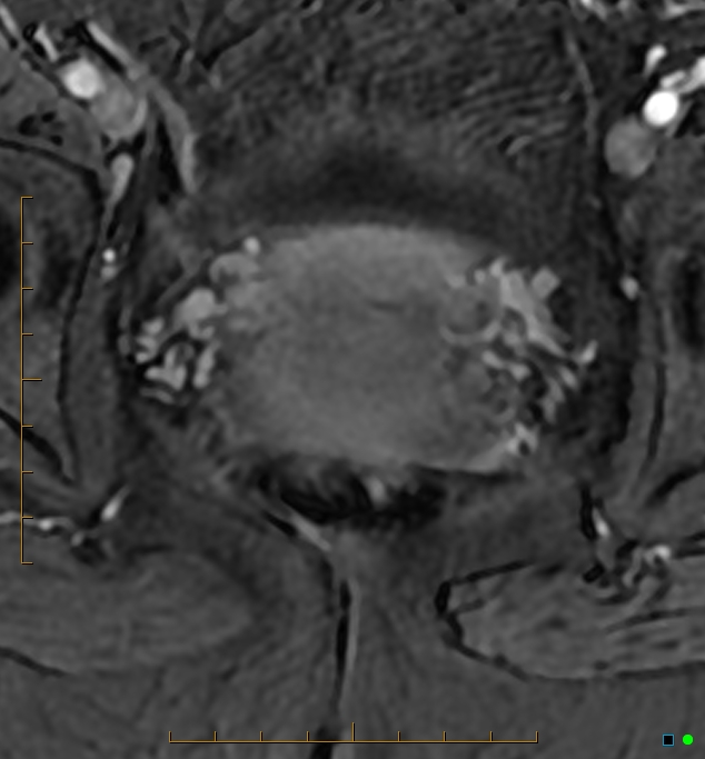 Adenomyosis uterus with hematometra (Radiopaedia 45779-50011 Axial T1 C+ fat sat 47).jpg