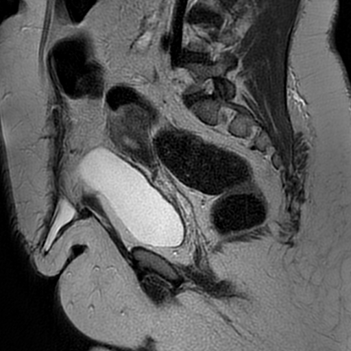 File:Adenomyosis within a didelphys uterus (Radiopaedia 70175-80215 Sagittal T2 15).jpg