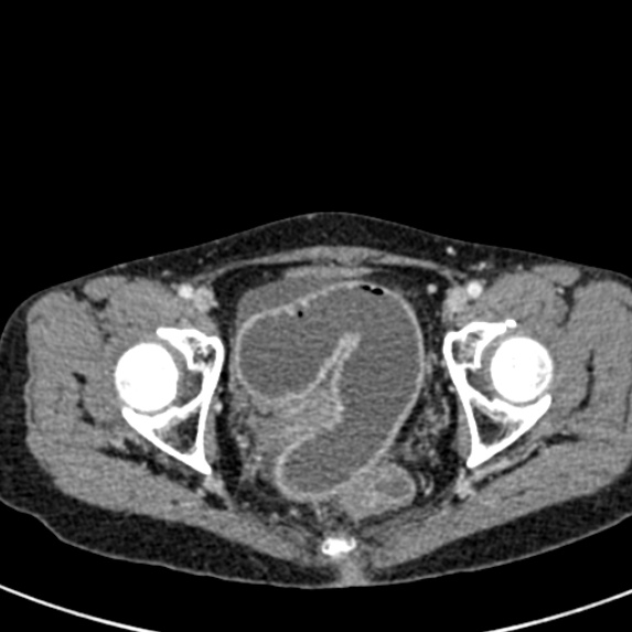 Adhesional small bowel obstruction (Radiopaedia 48397-53305 Axial C+ portal venous phase 86).jpg