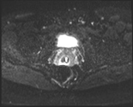 Adnexal multilocular cyst (O-RADS US 3- O-RADS MRI 3) (Radiopaedia 87426-103754 Axial DWI 19).jpg