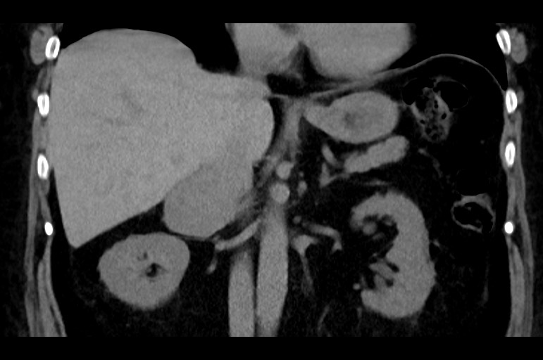 Adrenal cortical carcinoma (Radiopaedia 64017-72769 Coronal non-contrast 30).jpg