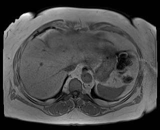 File:Adrenal cortical carcinoma (Radiopaedia 64017-72770 Axial T1 in-phase 6).jpg